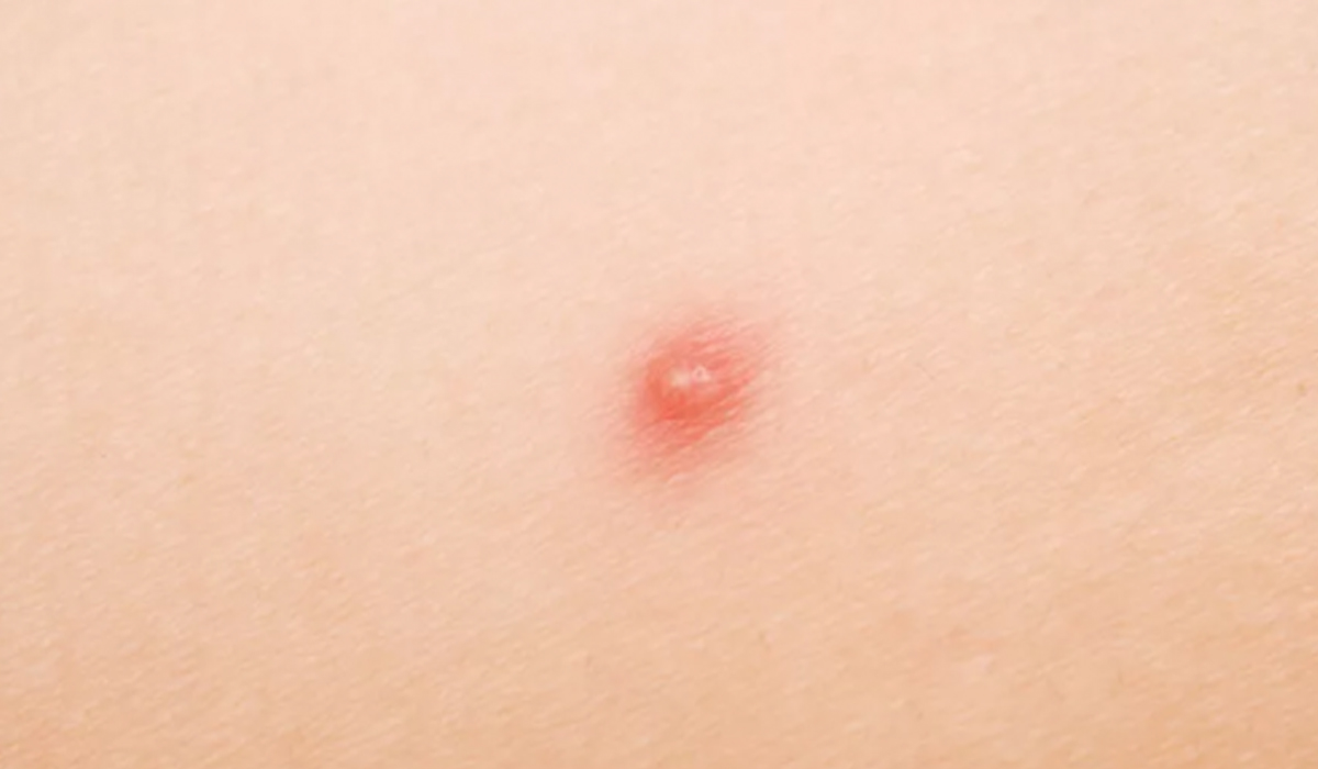 Causes of Little Red Dots on Skin- Things You Need To Know